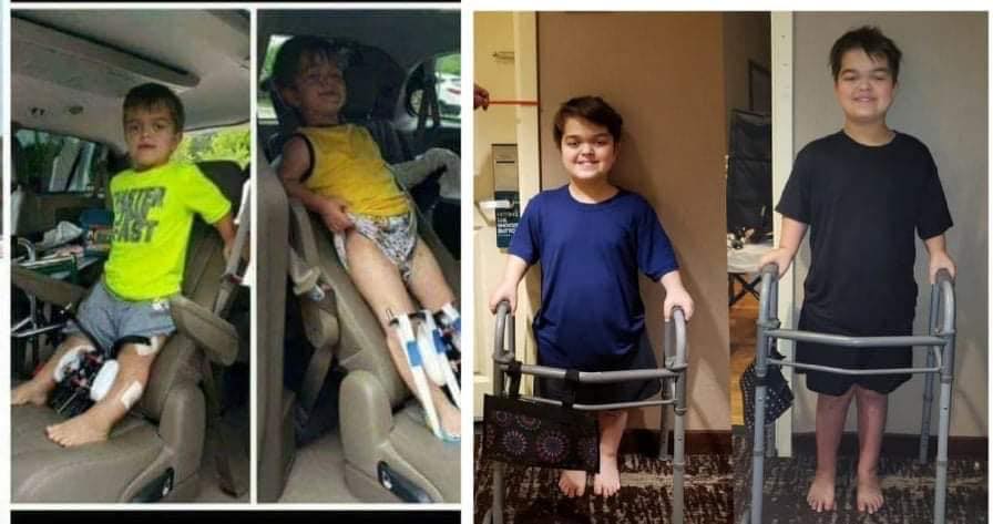 【肢体延长术成功案例】Paley研究院8年治疗软骨发育不全全过程