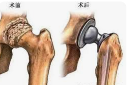 从股骨头坏死到全国赛场：Paley研究院精准矫形助力运动员重生