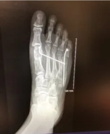 paley研究院精准破局：解开杰米三年求医无果的病症谜题