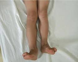 精准肢体重建：Paley研究院助力少年重获平衡人生